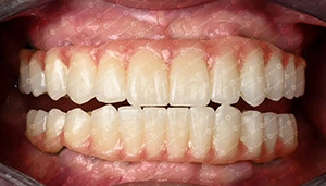 Dernière affaire concernant Une affaire de clientèle. Un bloc de zirconia 4D.