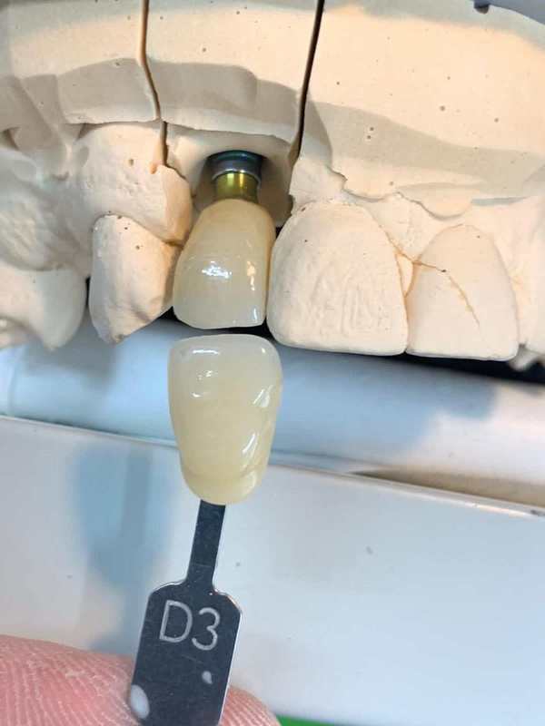 YUCERA Matériaux dentaires et de laboratoire de bonne qualité et à prix abordable et bloc de zircone dentaire Dis