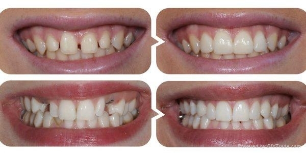 Yusera ST Color Super Translucent Color Preshade Zirconio Blanks Self-colored Dental Zirconia Blocks Cad Cam Lab Disc