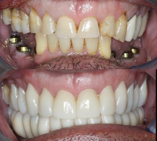 Bloc céramique en zircone spécifique Yucera 4D Pro Dental avec la technologie HT Plus améliorant la qualité des restaurations