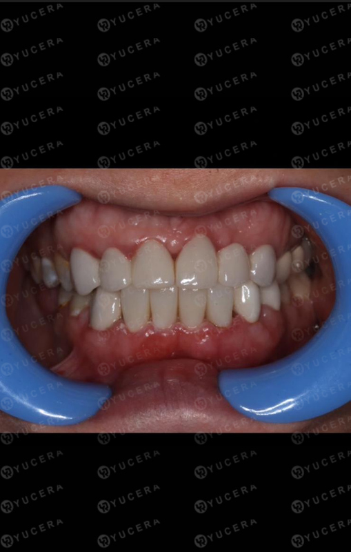 Blocs de zircone dentaire couleur Yucera ST : Votre choix de confiance pour des restaurations dentaires réalistes